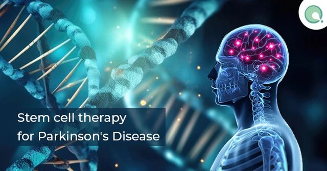 Stem-cell-therapy-for-Parkinsons-Disease.jpg