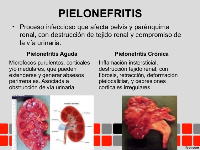 pielonefritis-infeccion-urinaria-alta.jpg