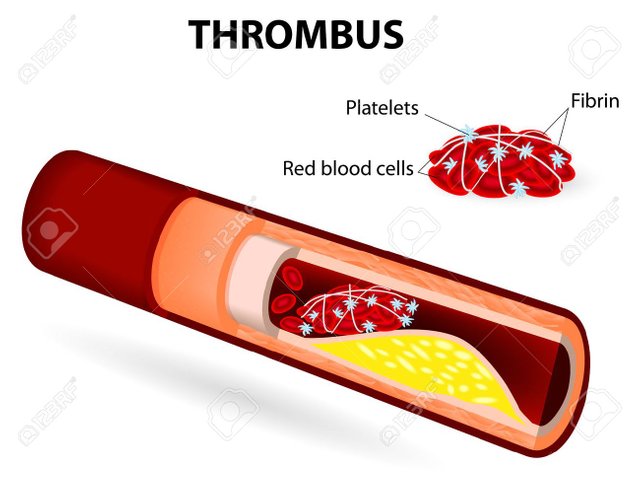 28507812-thrombus-blood-clot-vector-diagram-illustration-depicting-thrombus-formation-over-arterial-plaque.jpg