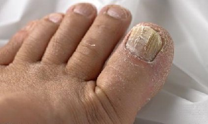 natural-remedies-for-toenail-fungus 2.jpg