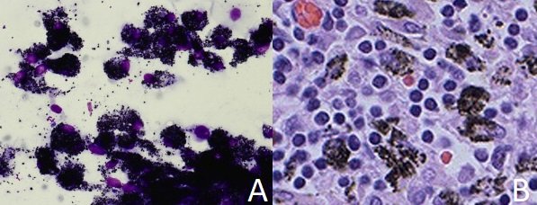 pylica cytologia i wezel.jpg