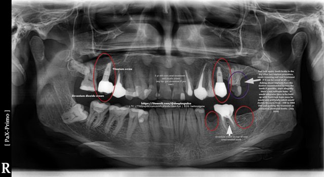 implants_explained_dl_201807_david.jpg