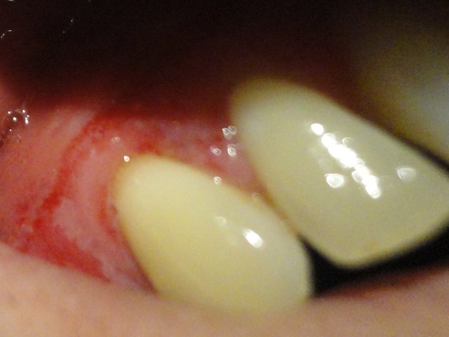 tooth rot.jpg