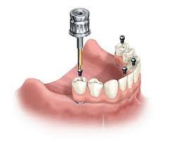 Dental Implants and Prosthetics Market.jpg