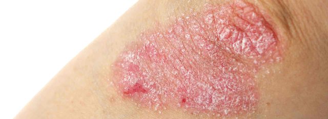 bigstock-Psoriasis-68407369.jpg