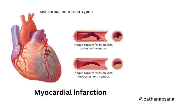 HEART ATTACK AND ITS CURE (3).jpg