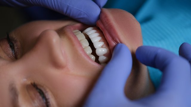 Veneers Miami.jpg