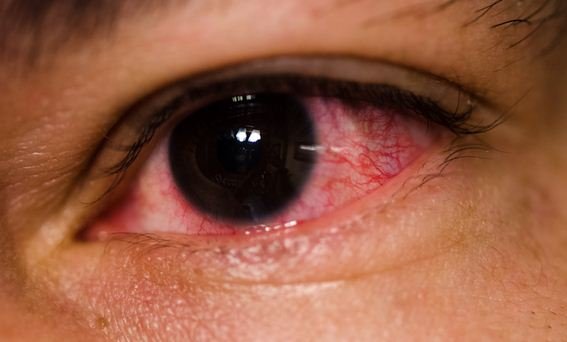 causes-of-red-eyes.jpg