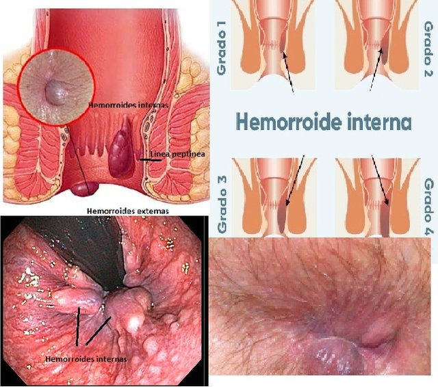tipos de hemorroides foto 3.jpg