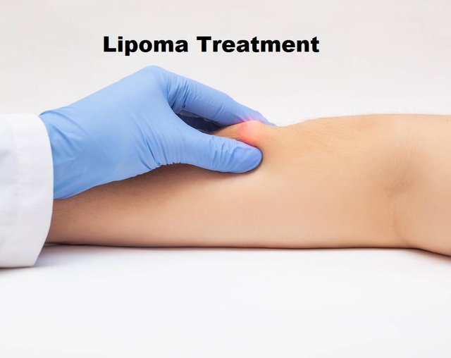 lipoma treatment.jpg