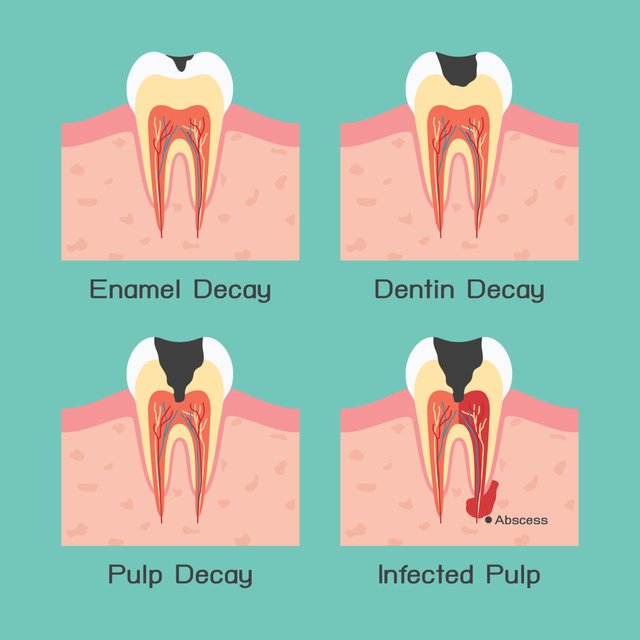 Tooth Decay.jpg