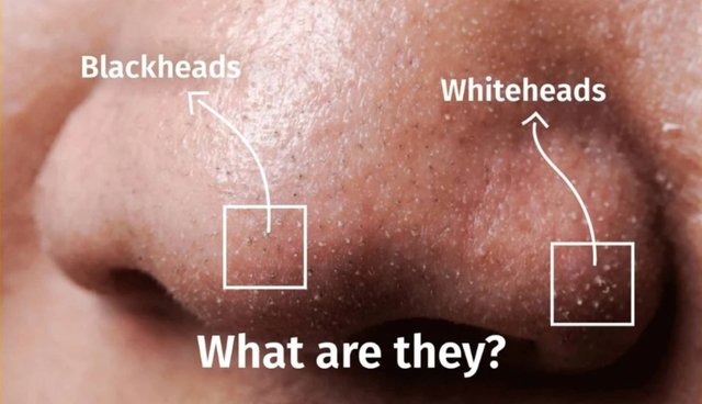 Whiteheads.jpeg