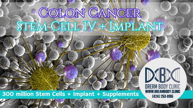 colon cancer stem cell treatment dreambody clinic youtube.jpg