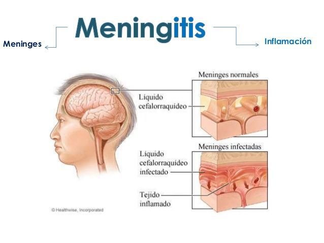 Meningitis2.jpg