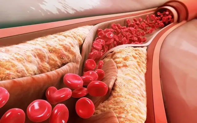 cholesterol-lifestyle.webp