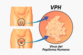 Precare  Human Papiloma Virus (HPV)
