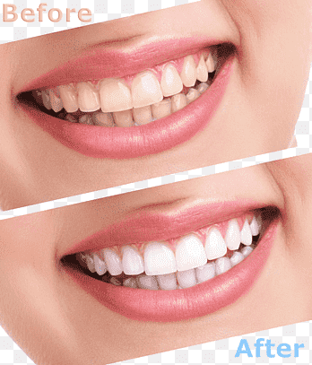 png-clipart-person-showing-teeth-collage-with-text-overlay-tooth-whitening-human-tooth-cosmetic-dentistry-comparison-of-cleaning-teeth-white-people-thumbnail.png