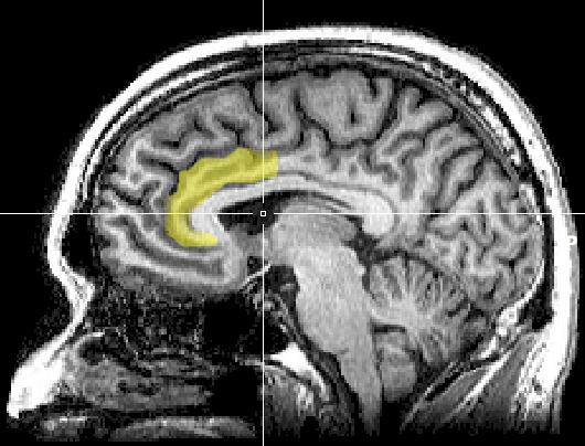 MRI_anterior_cingulate Geoff Hall, Public domain.png