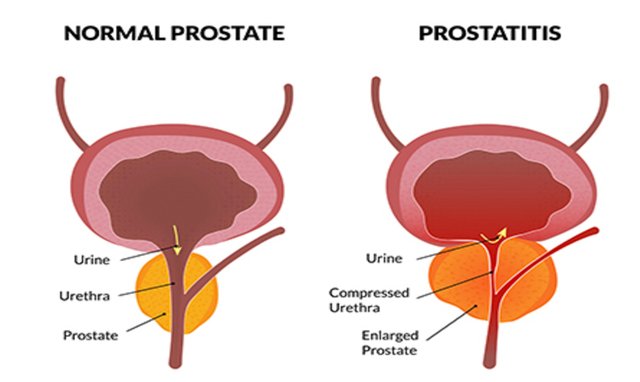 Prostatitis.jpg