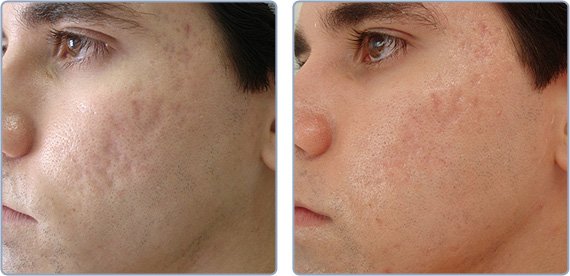 acne-scar-elimination-ba.jpg