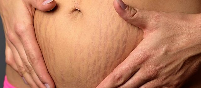 what-causes-stretch-marks.jpg