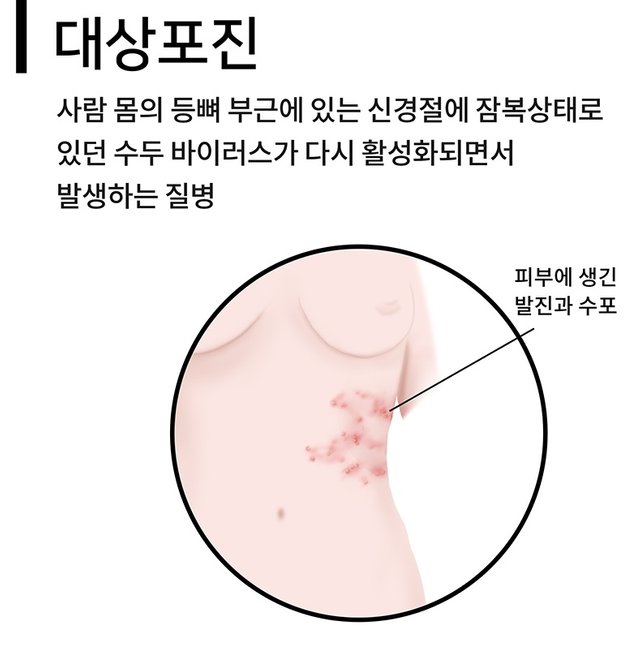 옆구리 통증 대상포진 통인한의원.jpg