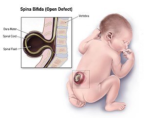 300px-Spina-bifida.jpg