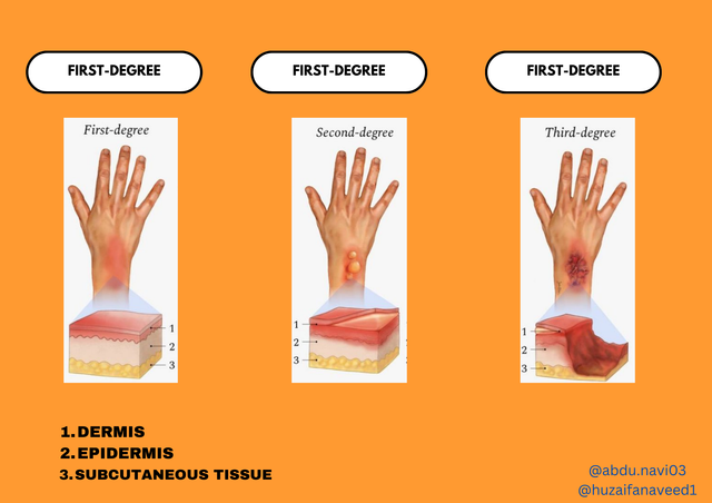 DEGREES OF BLEEDING.png