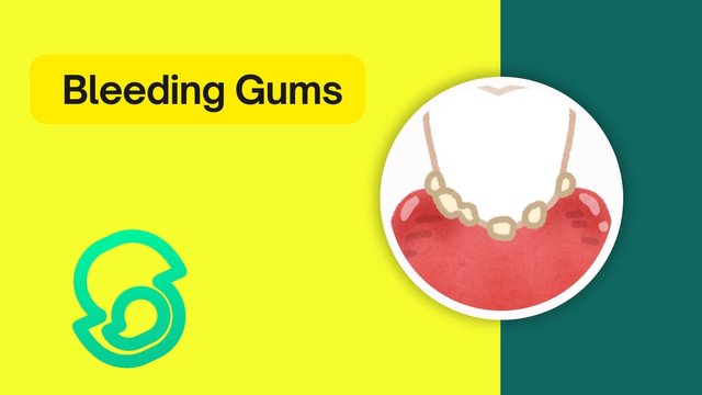 Bleeding Gums.jpg