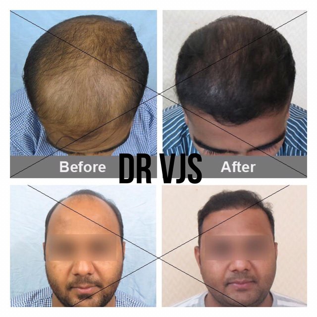 Hair translant Before and After Results (2).jpg