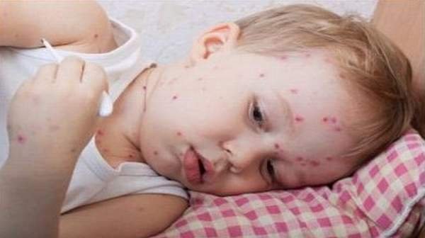 smallpox-1.jpg