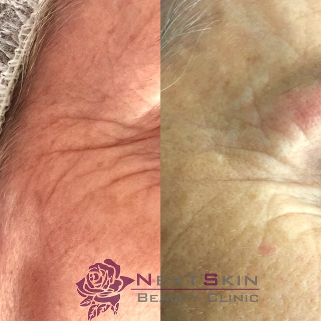 Microneedling voor en na foto.JPG