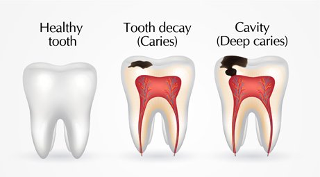 Browns-plains-dentist-decay-caries-cavities.jpg