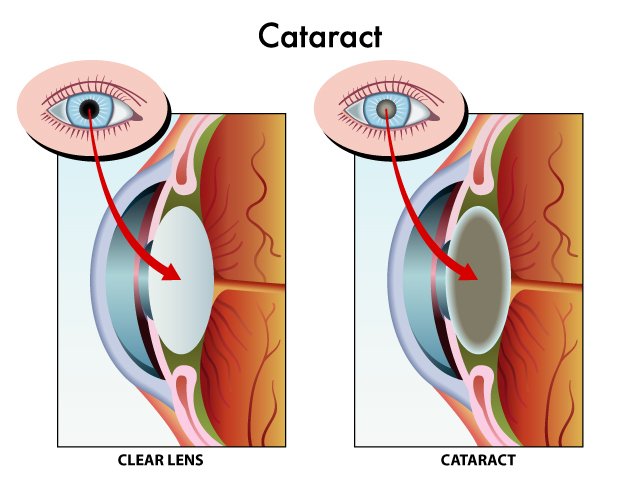 twin-falls-cataract-surgery.jpg