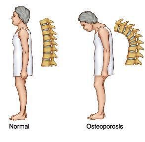 img_como_tratar_la_osteoporosis_6027_600.jpg