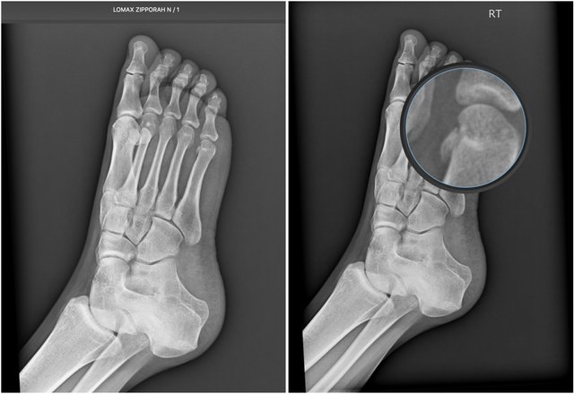 foot-chip(dyp).jpg