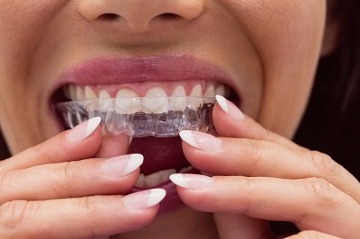 Everything You Should Know About Invisalign.jpg