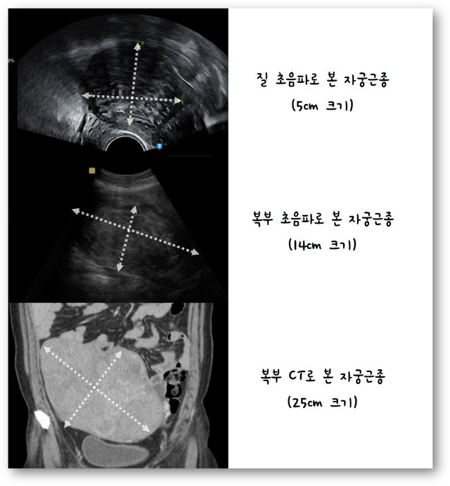 자궁근종 초음파.jpg