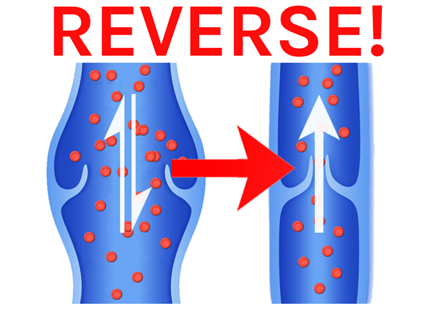 reverse varicocele.png