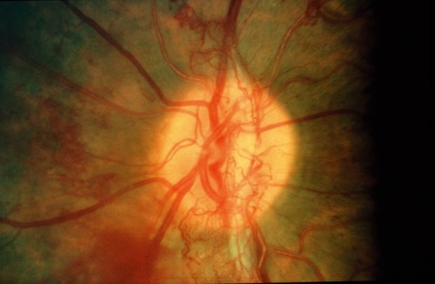 4 Essential Things to Know About Diabetic Retinopathy.jpg