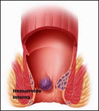 Hemorroides-Internas.jpg