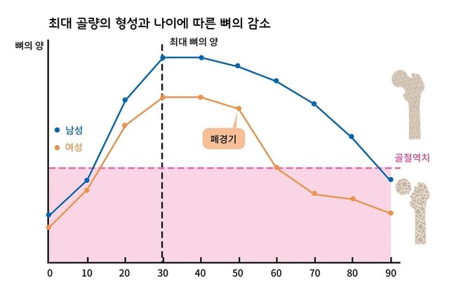 골다공증 나이에 따른 뼈의 감소 종각한의원 통인.jpg