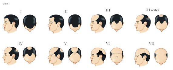 norwood_scale.jpg