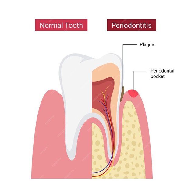 normal-human-teeth-compared-periodontitis_278713-1028.jpg