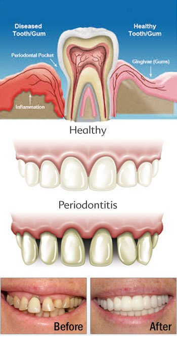 periodontal.jpg