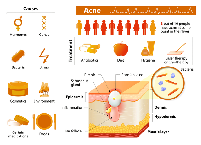 how-acne-forms-and-treatment.png