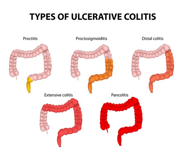forms-of-ulcerative-colitis.jpeg