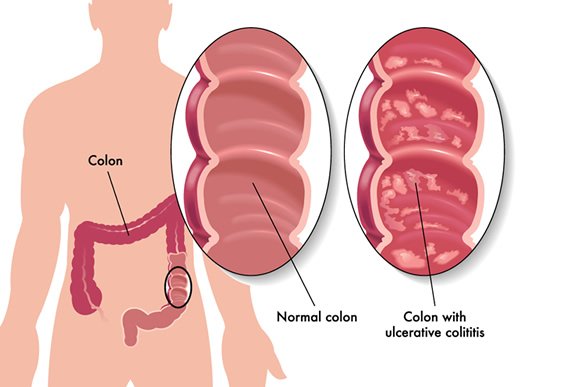 colitis treatment.jpg