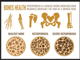 osteoporosis.png