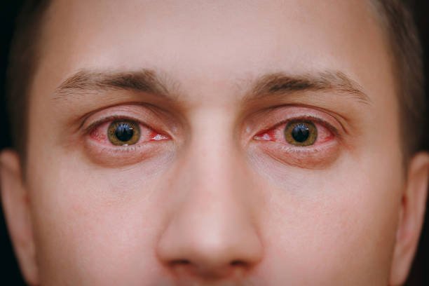 close-up-of-two-annoyed-red-blood-eyes-of-a-man-affected-by-conjunctivitis.jpg